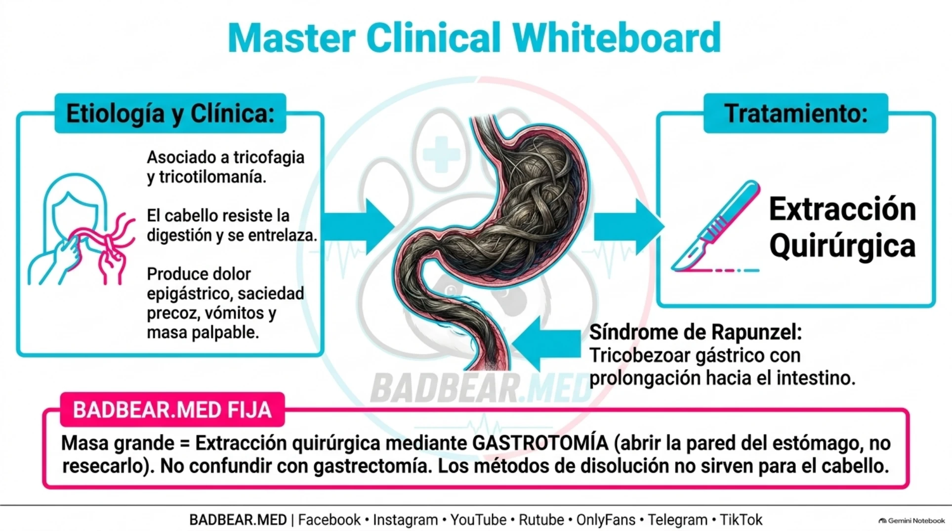 Esquema de masa de cabello gástrica con prolongación intestinal y gastrotomía